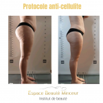 Le soin anti-cellulite LPG